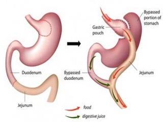 جراحی ضدچاقی
