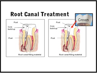 عصب کُشی دندان