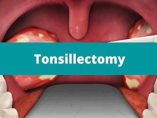 برداشتن لوزه