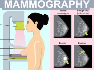 ماموگرافی