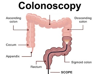 کولونوسکوپی