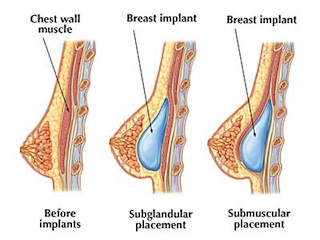 بزرگ کردن سینه